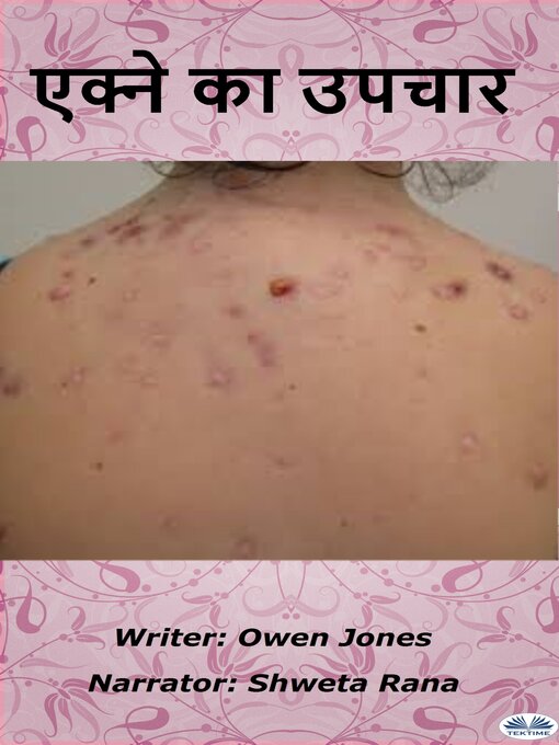 Title details for एक्ने का उपचार‎ by Owen Jones - Available
